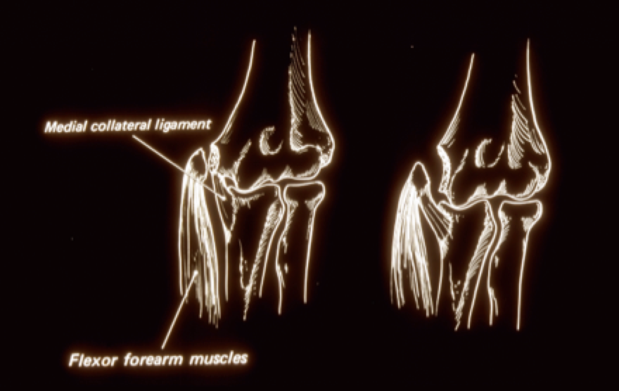 Flexor forearm muscles pulling away the medial humeral growth plate.